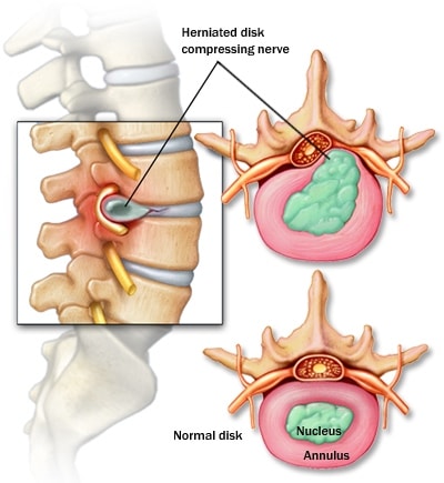 https://www.nashvilleneurosurgery.com/wp-content/uploads/2019/10/Cervical-and-Lumbar-Herniated-Disc.jpg