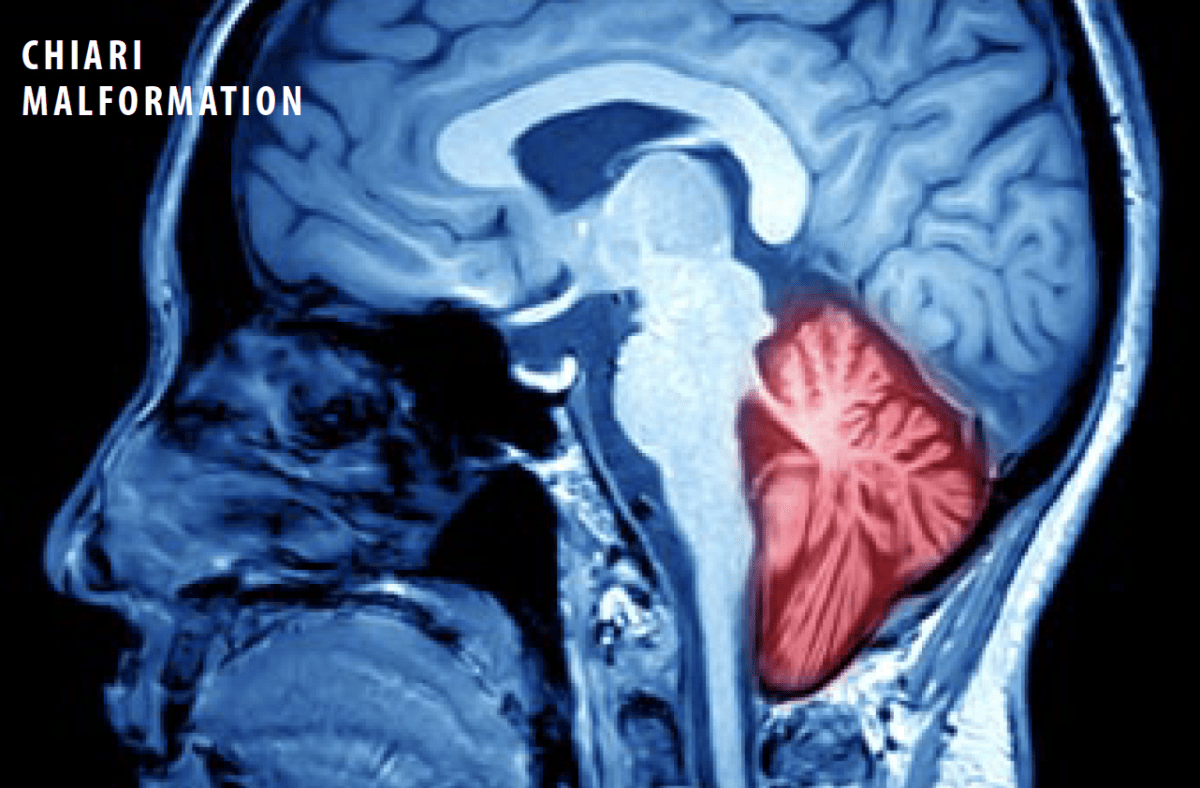 Chiari Malformations - Nashville Neurosurgery Associates