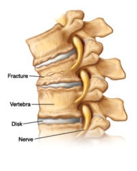 Spinal Fractures - Nashville Neurosurgery Associates