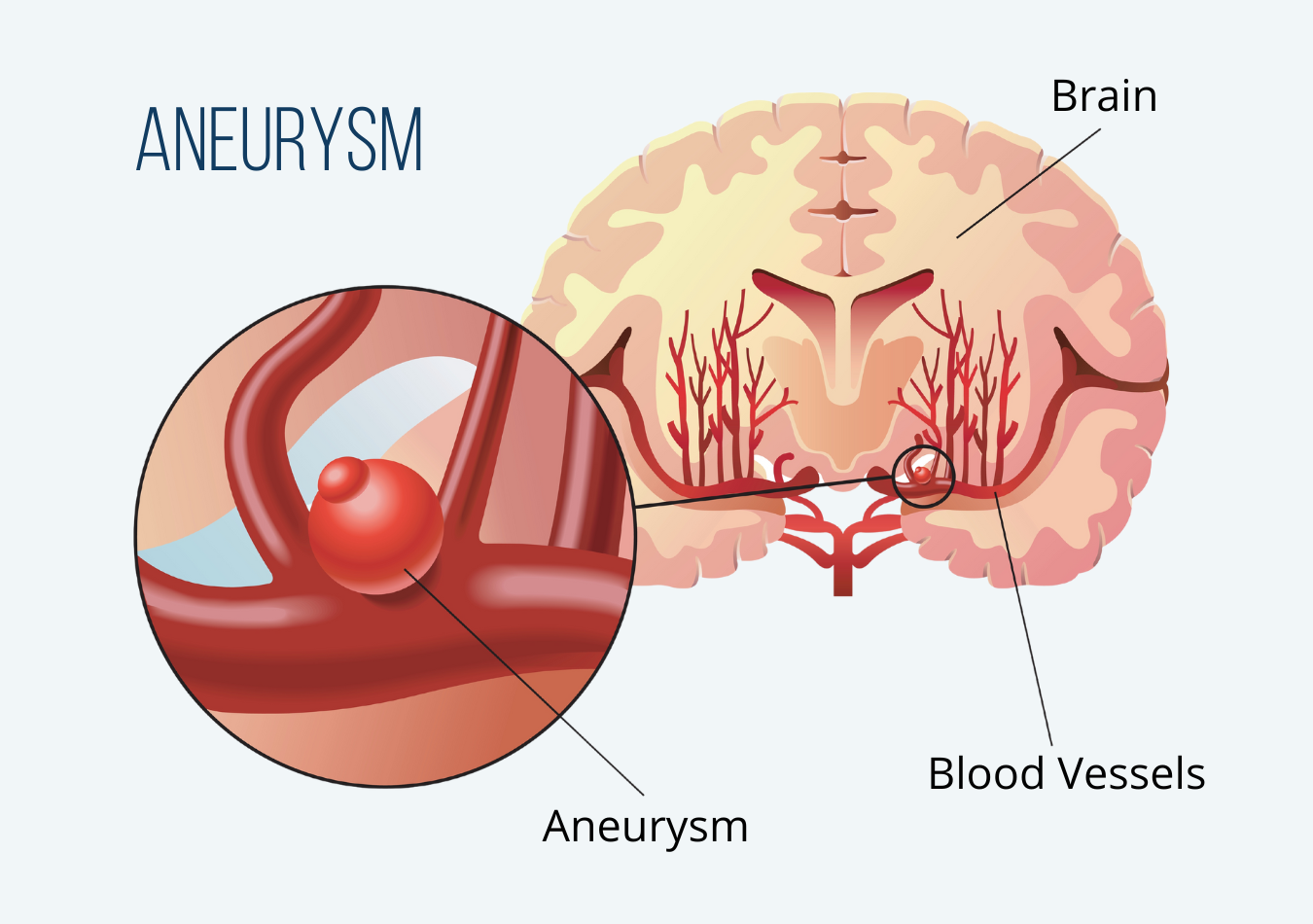 Migraine Vs Aneurysm Nashville Neurosurgery Associates 8632